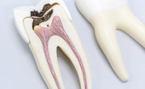 Odbudowa zęba po leczeniu endodontycznym; fot. istockphoto