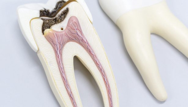 Odbudowa zęba po leczeniu endodontycznym; fot. istockphoto