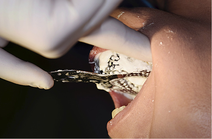 Metoda pobierania wycisków anatomicznych szczęki – wskazówki praktyczne