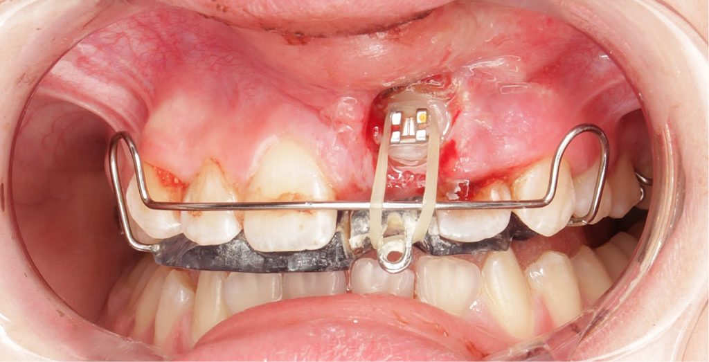 Leczenie ortodontyczne zatrzymanego siekacza centralnego szczęki
