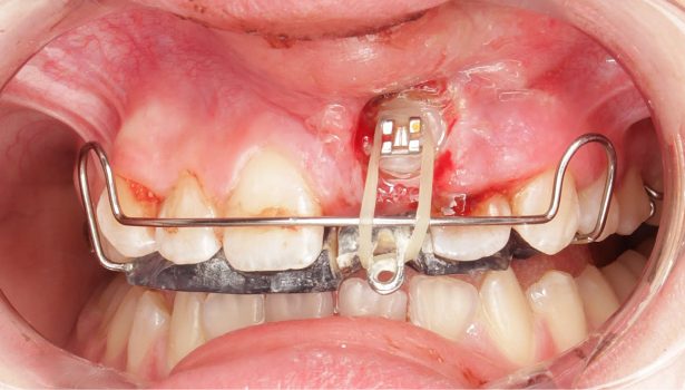 Leczenie ortodontyczne zatrzymanego siekacza centralnego szczęki