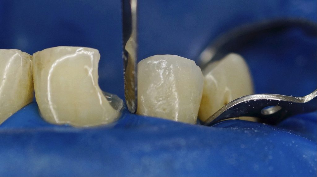 Rekonstrukcje bezpośrednie z zastosowaniem indeksu silikonowego