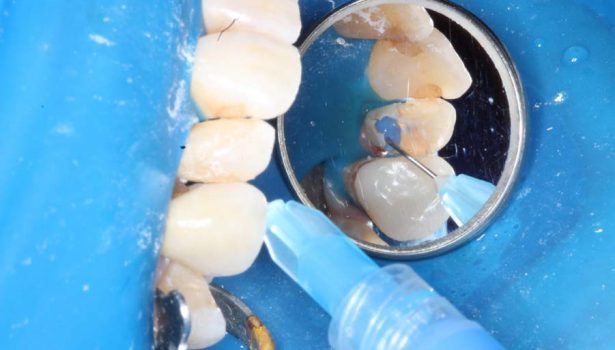 Jak prawidłowo stosować cement bioaktywny?