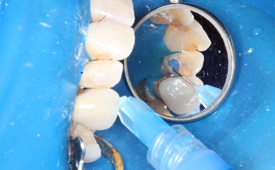 Jak prawidłowo stosować cement bioaktywny?