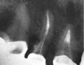 Chirurgiczne leczenie perforacji korzenia zęba