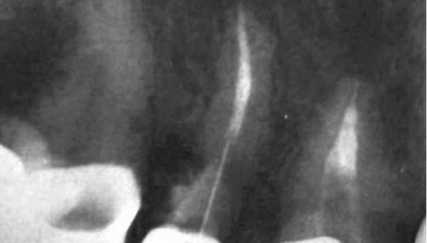 Chirurgiczne leczenie perforacji korzenia zęba