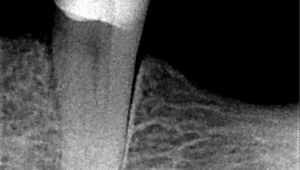 Leczenie endodontyczne zębów