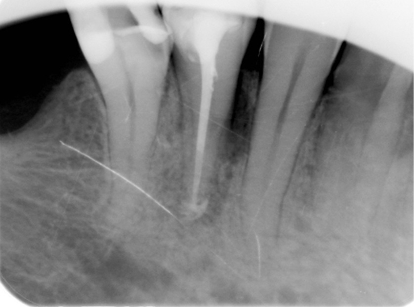 EWP_1_18_LECZENIE_DWUKANALOWYCH_ZEBOW_PRZEDTRZONOWYCH_RYC_16