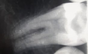 leczenie endodontyczne