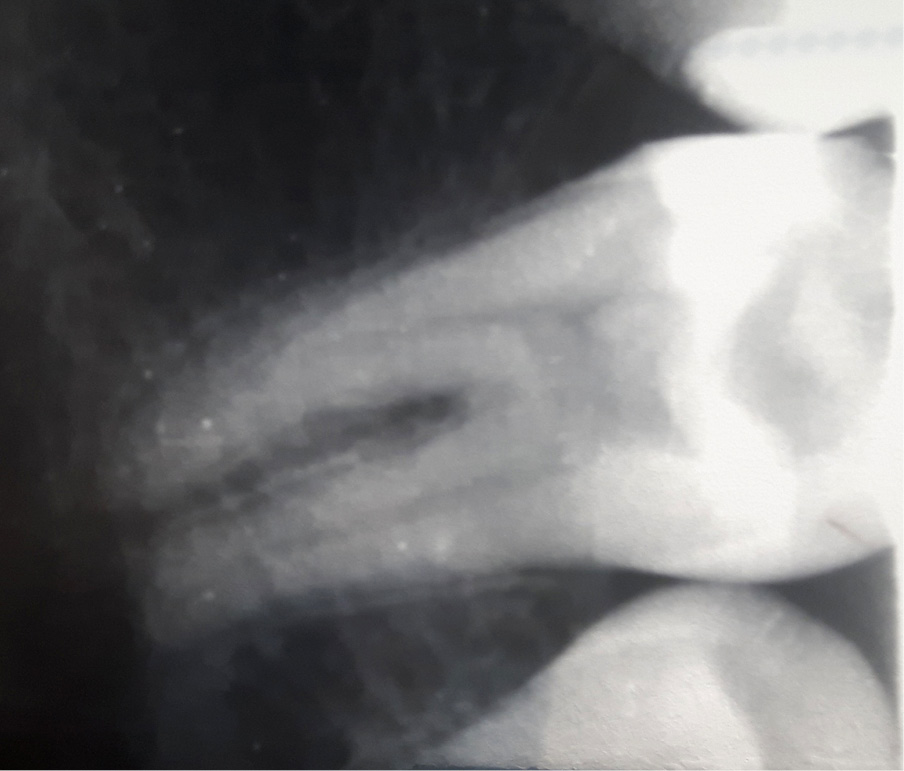 leczenie endodontyczne