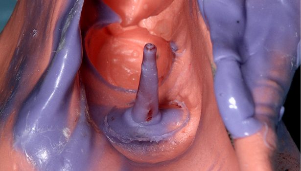 wkłady koronowo-korzeniowe