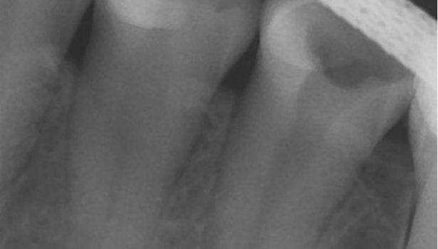 Leczenie przewlekłych zapaleń