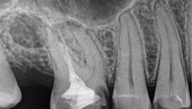 Przewlekłe zapalenie tkanek