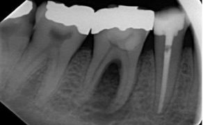 endo-perio