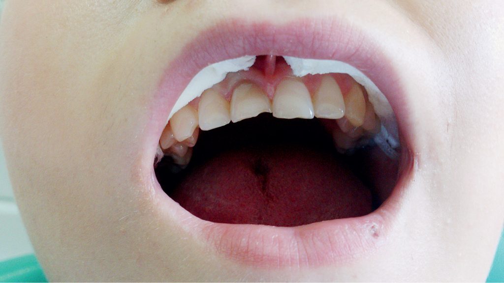 Leczenie przy użyciu tradycyjnych metod