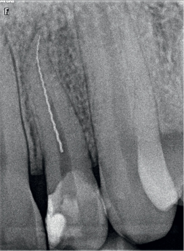 Zamanie narzędzi w kanale korzeniowym