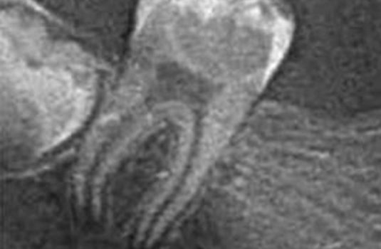 Amputacja całkowita miazgi