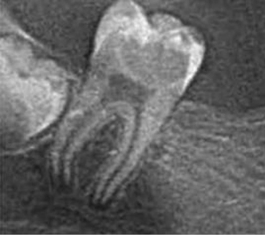 Amputacja całkowita miazgi