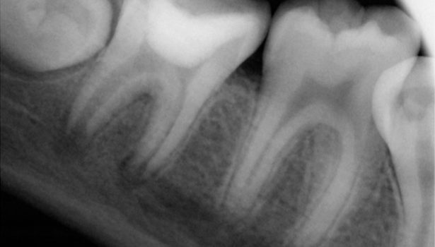 Regeneracja miazgi i ozębnej