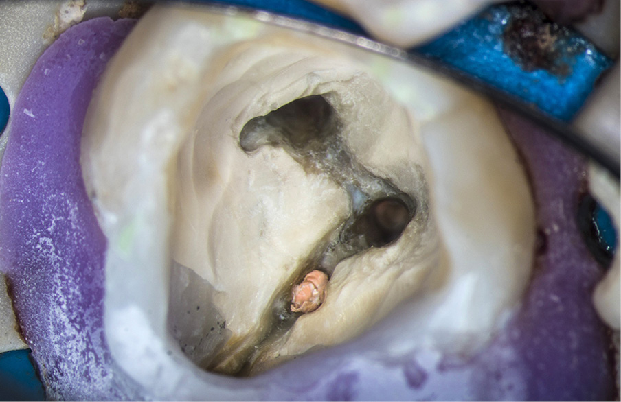 EWP_2_18_LECZENIE_KANALOWE_DRUGICH_ZEBOW_TRZONOWYCH_ZUCHWY_O_NIETYPOWEJ_ANATOMII_RYC_50