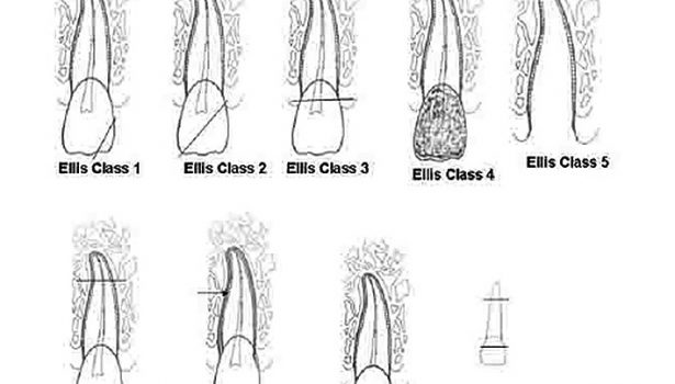 Leczenie martwych zębów stałych