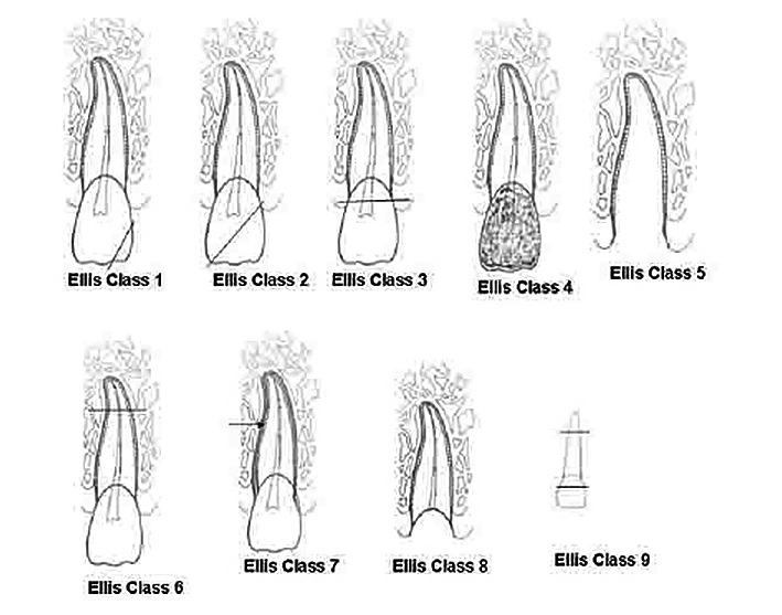 Leczenie martwych zębów stałych