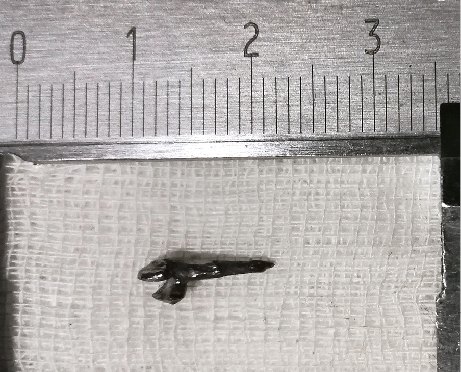 EWP_2_18_PONOWNE_LECZENIE_KANALOWE_ZEBOW_WZMOCNIONYCH_WKLADAMI_KORONOWO_KORZENIOWYMI_RYC_4_B