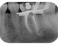 Wyniki leczenia endodontycznego