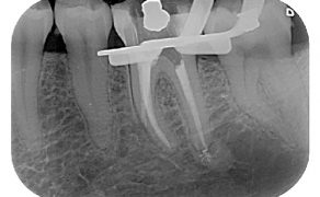 Wyniki leczenia endodontycznego