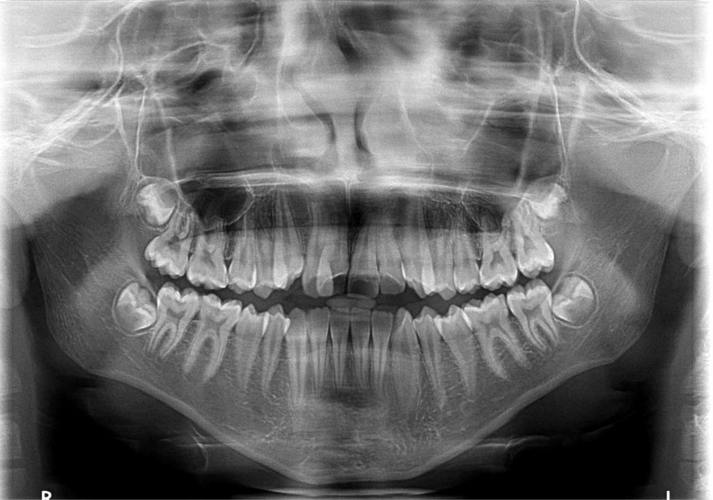 TPS_6_20_ortodoncja_LECZENIE_ROSNACEGO_PACJENTA_Z_WADA_ZGRYZU_KLASY_III_FOT_3