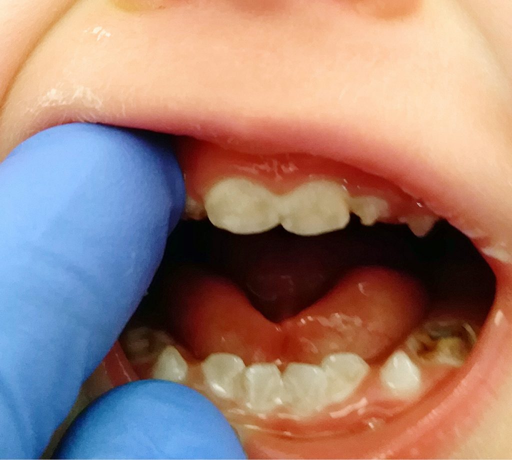 TPS_6_20_PODEJRZENIE_ZESPOLU_ACRO_CARDIO_FACIAL_ACFS_FOT_2