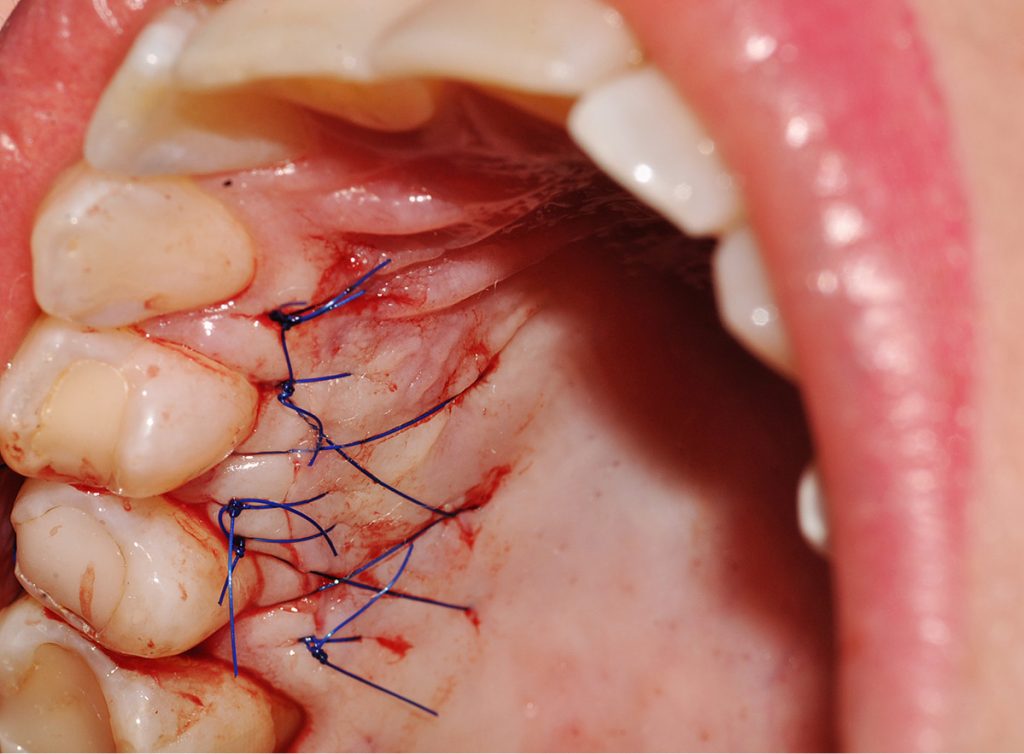 Wykorzystanie lasera diodowego