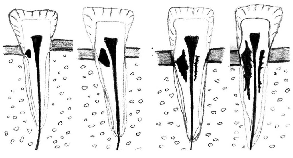Resorpcja zewnętrzna przyszyjkowa
