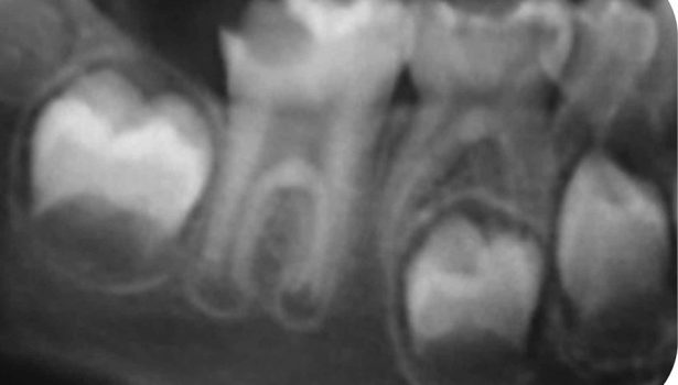 Rewaskularyzacja miazgi