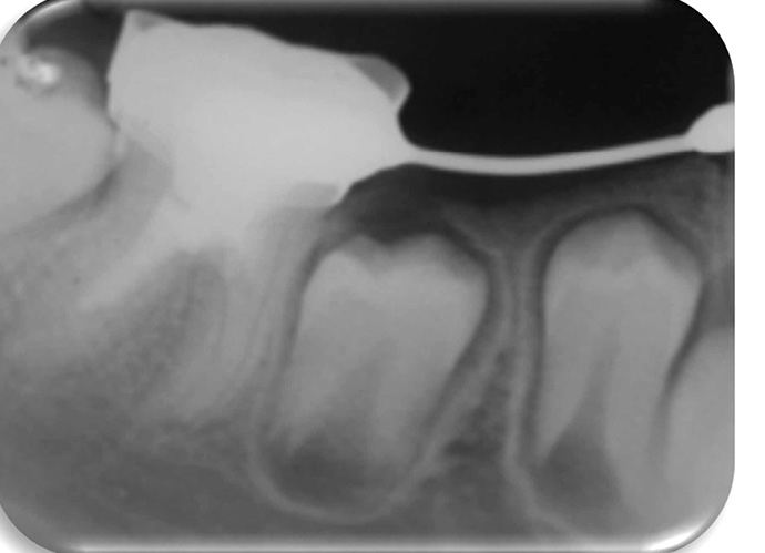 EWP_3_18_REWASKULARYZACJA_MIAZGI_NIEDOJRZALYCH_ZEBOW_RYC_5_D