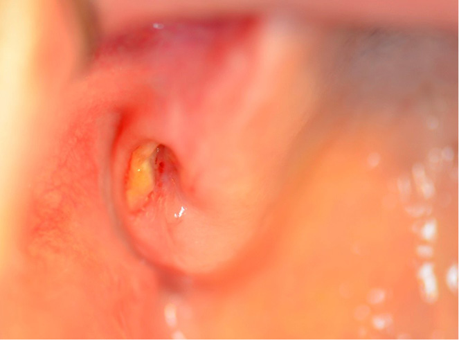 przyczyna martwicy kości