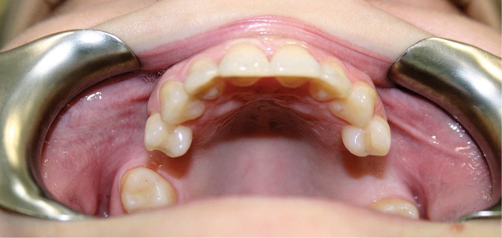 Technika otwarta sinus lift