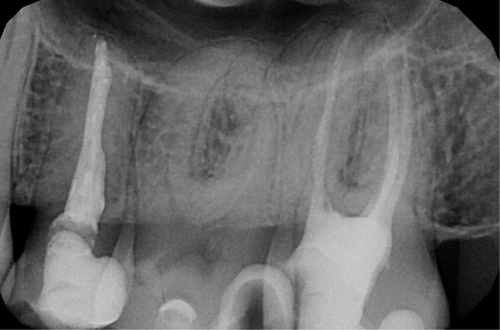 TPS_7-8_20_endowakacje_LECZENIE_ENDODONTYCZNE_ZEBOW_ZE_ZNACZNA_KRZYWIZNA_KANALOW_FOT_1