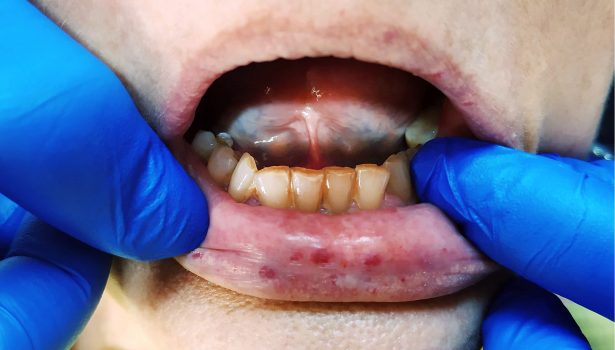 Manifestacja choroby Rendu-Oslera-Webera