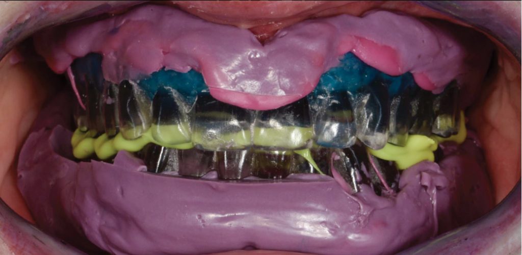 overdenture