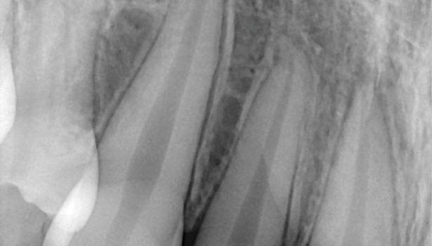 Resorpcja zewnętrzna zamienna korzenia