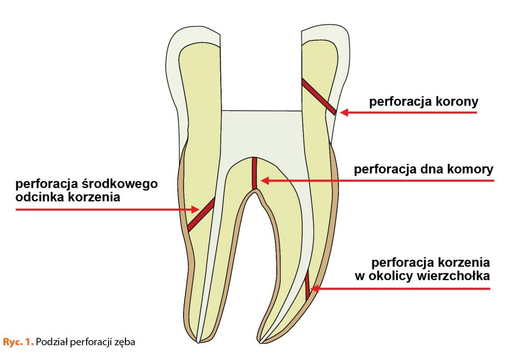 TPS_7-8_20_endowakacje_ZAMKNIECIE_PERFORACJI_KORZENIA_PRZY_UZYCIU_MTA_RYC_1