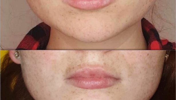 Zastosowanie toksyny botulinowej