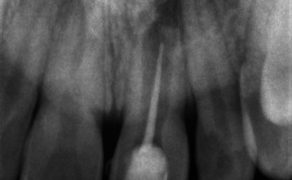 Endodontyczne leczenie