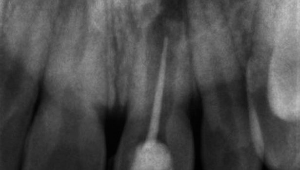 Endodontyczne leczenie