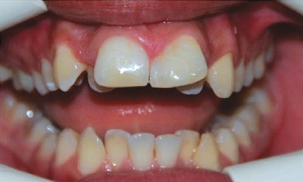 EWP_2_17_LECZENIE_ENDODONTYCZNE_I_ODBUDOWA_ESTETYCZNA_ZDWOJONEGO_SIEKACZA_7_A