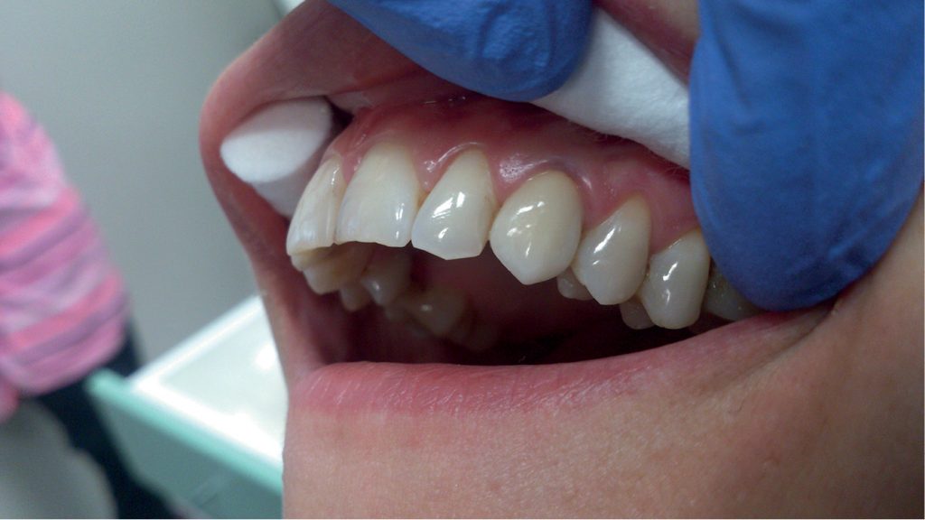 EWP_2_17_POURAZOWA_ESTETYCZNA_ODBUDOWA_ZEBA_23_KORONA_PROTETYCZNA_RYC_15