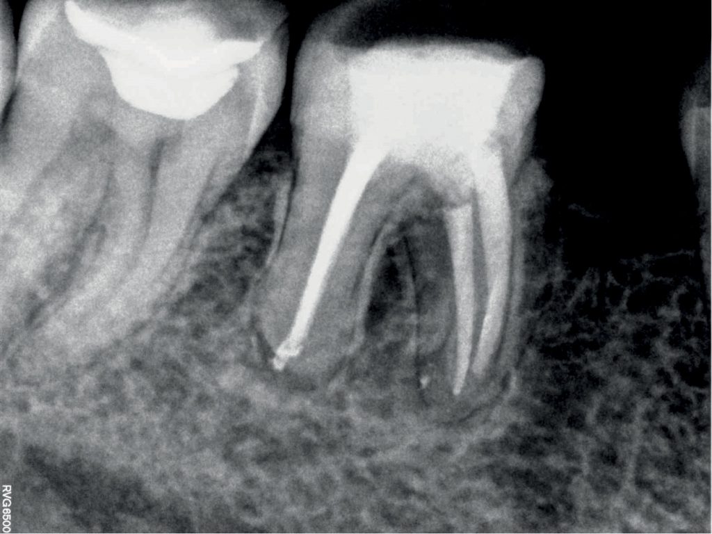 EWP_2_17_LECZENIE_KANALOWE_U_PACJENTOW_CHORYCH_NA_CUKRZYCE_RYC_2