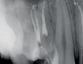 Leczenie endodontyczne trójkanałowych przedtrzonowców