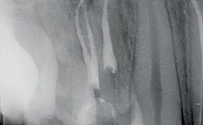 Leczenie endodontyczne trójkanałowych przedtrzonowców